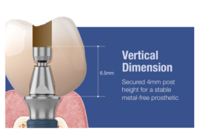 AXA Abutment – Metal-Free Simplicity for Full-Mouth Prosthetics