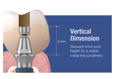 AXA Abutment – Metal-Free Simplicity for Full-Mouth Prosthetics