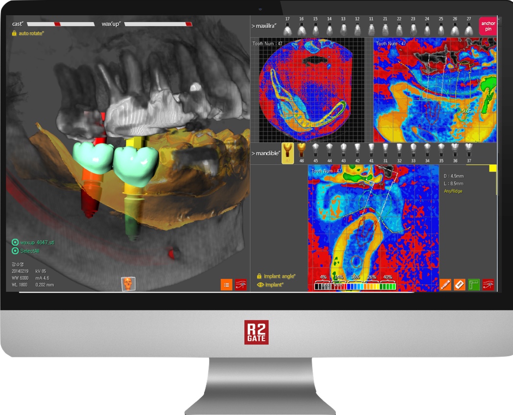 MegaGen R2GATE® Implant Planning Software